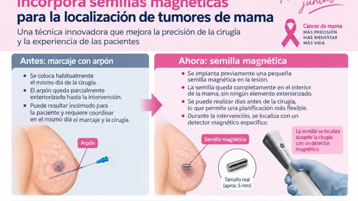 Infografía explicativa sobre semillas magnéticas para localización de tumores de mama en el Hospital General Sierrallana, comparando la técnica anterior con arpón y la nueva con detector magnético